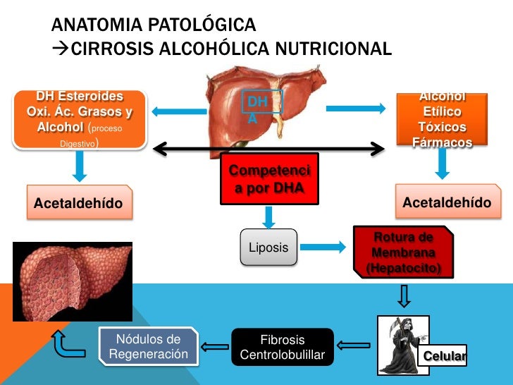 cirrosis hepatica alcoholica nutricional chan